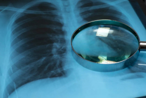 咳嗽持续多少天会变白肺？第几天要做 CT？有这些信号立即去医院 ！