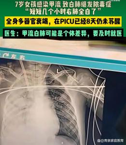 7歲女孩感染甲流幾個小時右肺全白 甲流危害引警惕