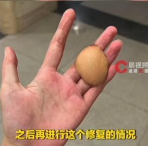 00后女生手指被电伤从肚子借肉移植 乐观面对未来