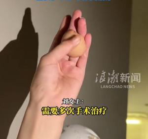 女子手掌被电击后长出“猫爪肉垫” 电伤需多次手术修复