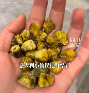 意大利小偷闯入公寓偷“宝盒” 误将肾结石当黄金