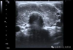 32岁女子突然不对劲，心脏、肝脏等器官全部罢工！