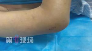 一根输液管差点要了老人的命 感染危机险致命