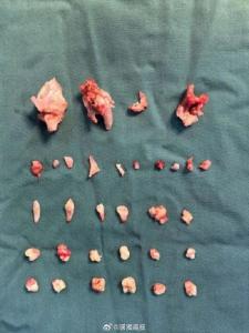 18岁女孩腹中肿块里还有24颗牙齿 卵巢畸胎瘤惊现牙齿骨骼