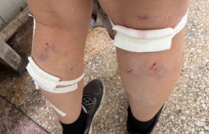 被群狗围攻女生被诊断为狂犬病Ⅲ级暴露 校园安全引关注