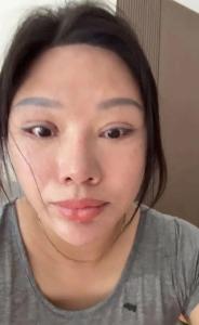 女子割双眼皮后无法闭眼，整形机构老板获刑后反起诉，女子被判退还20万元 整形失败引发法律纠纷