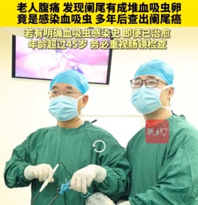 老人感染血吸虫多年后查出阑尾癌