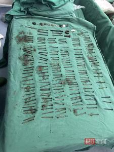 精神病男子吞食180颗铁钉被取出 胃内异物震惊众人