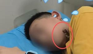 12岁男孩湖边玩耍被鱼钩刺入脸部 消防员精准切割救助