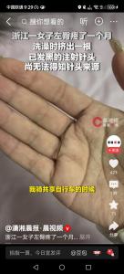 臀部取出针头女子每天骑共享单车 异物潜伏一个月