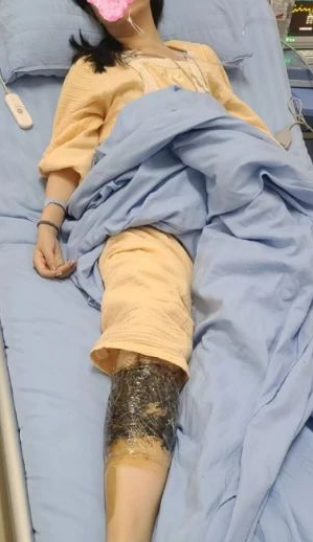 女子簡述在酒店被毒蛇咬傷 后遺癥持續(xù)兩年
