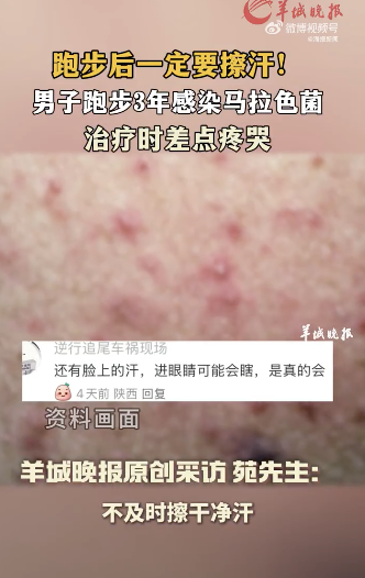 男子跑步后未擦汗感染馬拉色菌