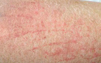 阳性期间出现身上痒别不当回事:如果是药物过敏有风险!_中华网