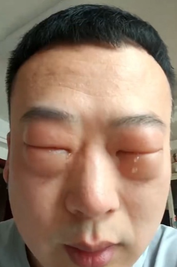 男子吃蚕蛹10分钟后变肿眼包 食物过敏需警惕