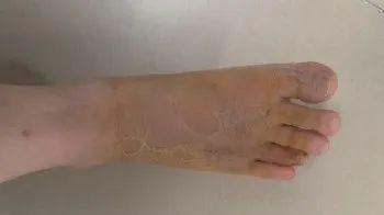 男子在沙發(fā)上睡了一覺險(xiǎn)截趾 蟲咬引發(fā)嚴(yán)重感染