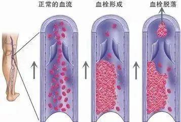 春節(jié)回家小心經(jīng)濟艙綜合征 旅途中的隱形健康殺手