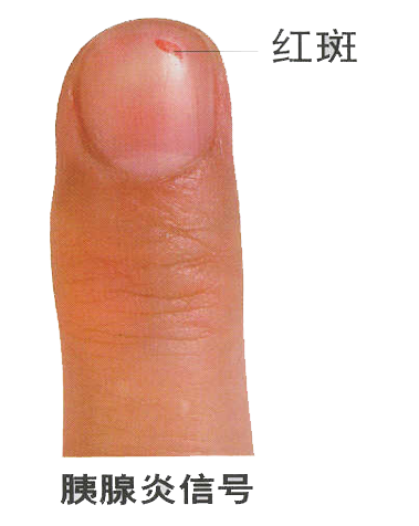 男子手指甲发紫直到胸痛才重视 忽视身体信号险酿大祸