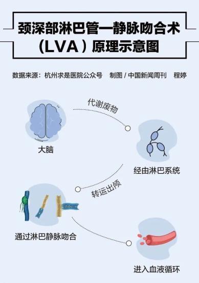 全国叫停LVA手术治疗阿尔茨海默病 争议与真相待解