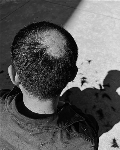 02年小伙长期熬夜成重度斑秃