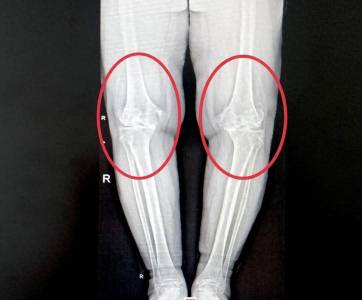 协和医生辟谣：骨关节炎真的是冻出来的吗？