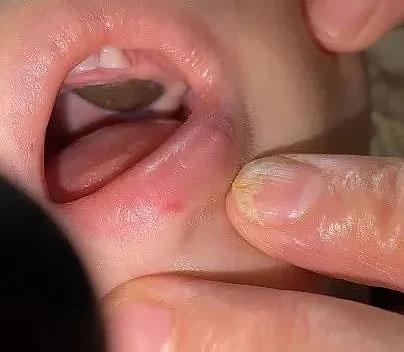 专家误诊？莲子壳粘嘴里湘雅医生诊断为肿瘤