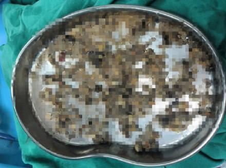 男子手术后取出结石摆满整盘 在钬激光碎石机的助力下逐一将结石击碎