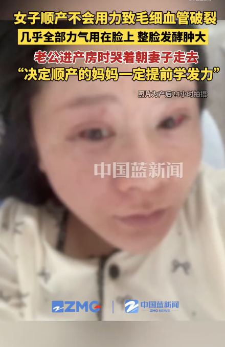 顺产妈妈用错力致整脸肿胀：女子顺产完脸部毛细血管破裂