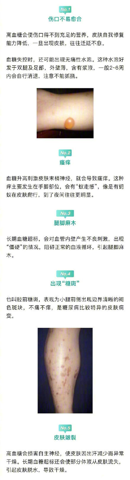 醫(yī)生說下肢是人體自帶的血糖儀