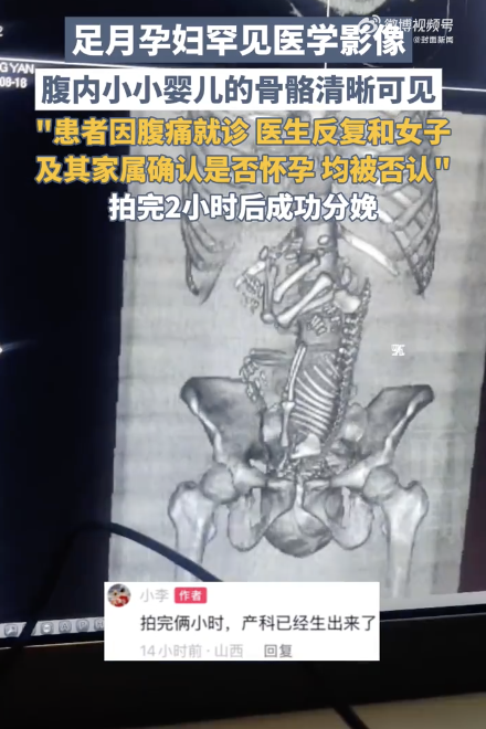 医生分享足月孕妇罕见的医学影像