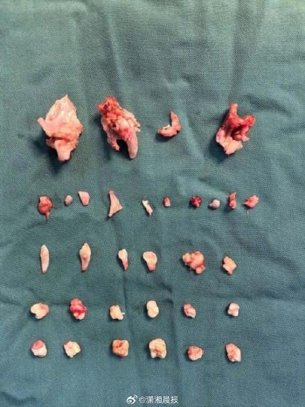 18岁女孩腹中肿块里还有24颗牙齿 卵巢畸胎瘤惊现牙齿骨骼
