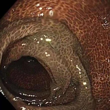 女子便秘10年被切30厘米肠管 长期滥用通便茶的代价