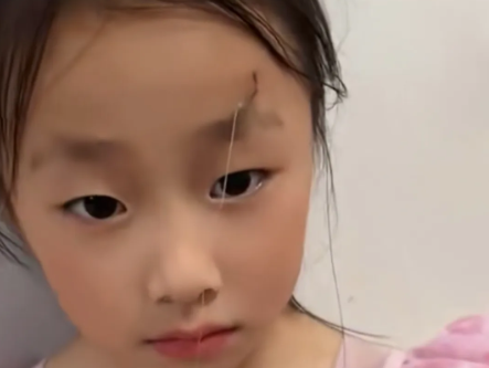 爸爸误将鱼钩扎女儿脸上 乞求女儿别告诉妈妈