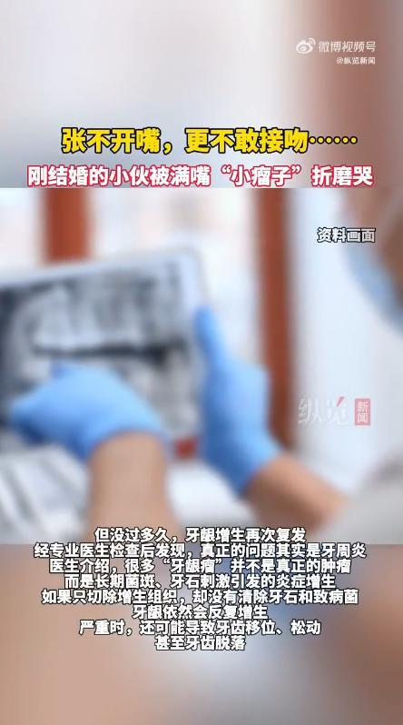 小伙新婚满嘴“小瘤子”不敢接吻 牙周炎惹的祸