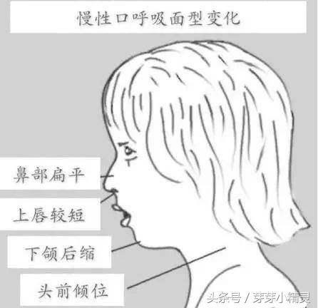 口呼吸会让人变丑是真的吗 经口呼吸面容图片大全