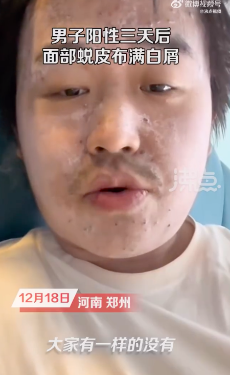 男子阳性3天后面部蜕皮布满白屑