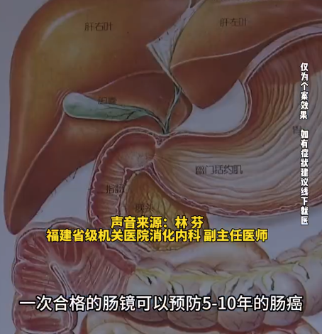 一级亲属有肠癌史本人风险高2倍 一次合格肠镜可防5-10年肠癌