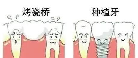 烤瓷牙与种植牙怎么选？比比就知道！