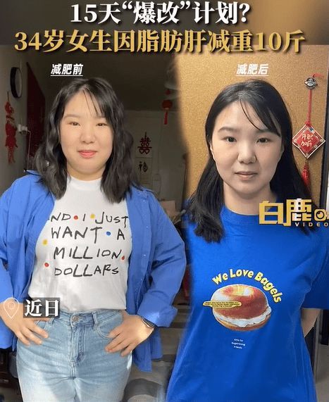 34岁南京女生因脂肪肝15天减重10斤