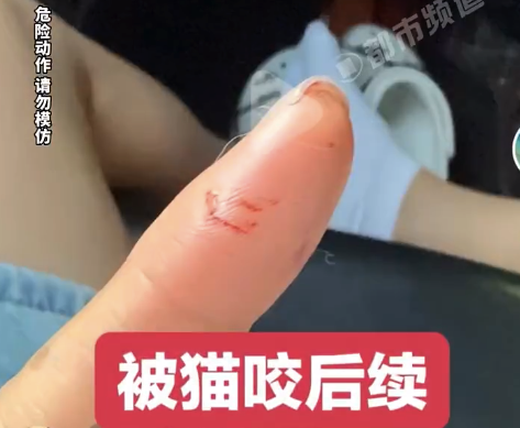 女子被流浪猫咬伤手指确诊骨髓炎需手术 