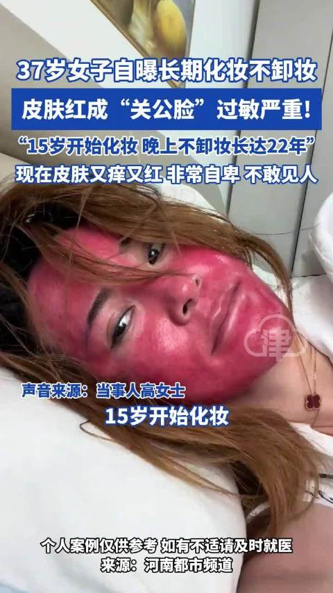 女子回應(yīng)22年化妝不卸妝嚴(yán)重過(guò)敏 護(hù)膚誤區(qū)引熱議