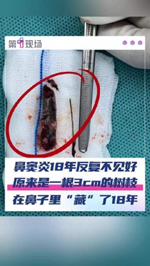 男子鼻炎18年元凶是眼角插入的树枝