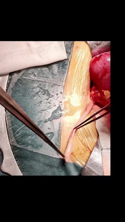 手术成功!妻子跨越血型障碍捐肾救夫