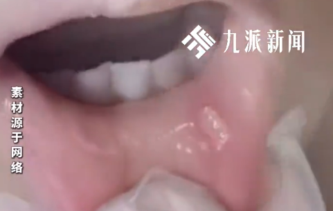 36岁男子反复口腔溃疡20年以为上火，自行停药致失明，医生：右眼视力已无法恢复，左眼好转
