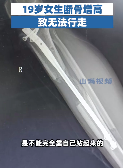 19岁女生断骨增高后无法行走！断骨增高四个字听起来不可怕吗