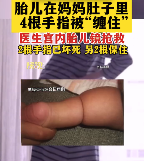 媽媽腹中胎兒4根手指被纏繞2根壞死，如不干預(yù)可能會(huì)導(dǎo)致先天性截肢