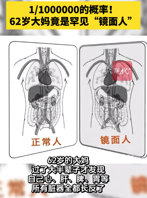 镜面人发生率为百万分之一 大妈活了大半辈子才知心肝脾长反了