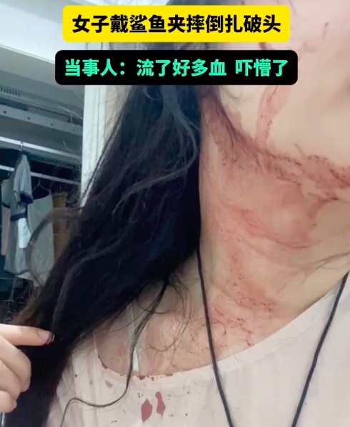 女子戴鯊魚(yú)夾貧血暈倒扎破頭,！提醒：小的鯊魚(yú)夾也同樣危險(xiǎn)