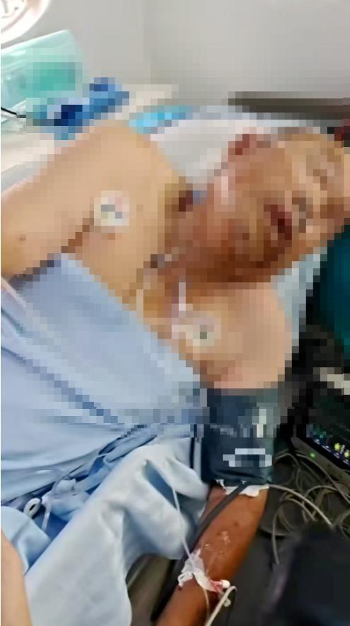 夫妻散步被马蜂蜇200多处 双双进ICU
