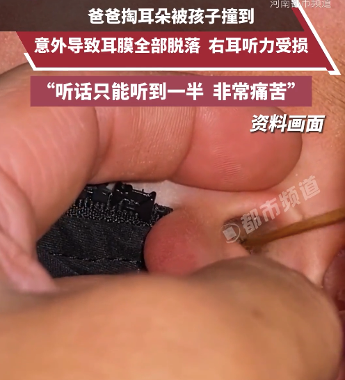 男子掏耳朵被2歲兒子撞致鼓膜脫落 醫(yī)生：需觀察半個月后再評估恢復(fù)情況