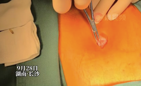 肚脐眼竟成了蛆虫的“安乐窝”！73岁大爷肚脐眼里有活蛆蠕动 